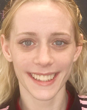 Restorative Dentistry Dental Implants - My Harmony Smiles