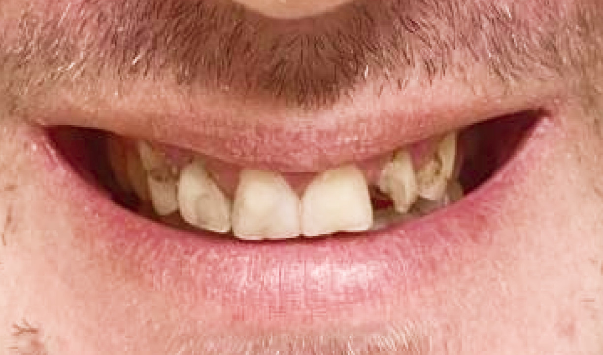 Restorative Dentistry Dental Implants - My Harmony Smiles