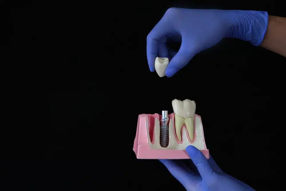 Restorative Dentistry Dental Implants - My Harmony Smiles