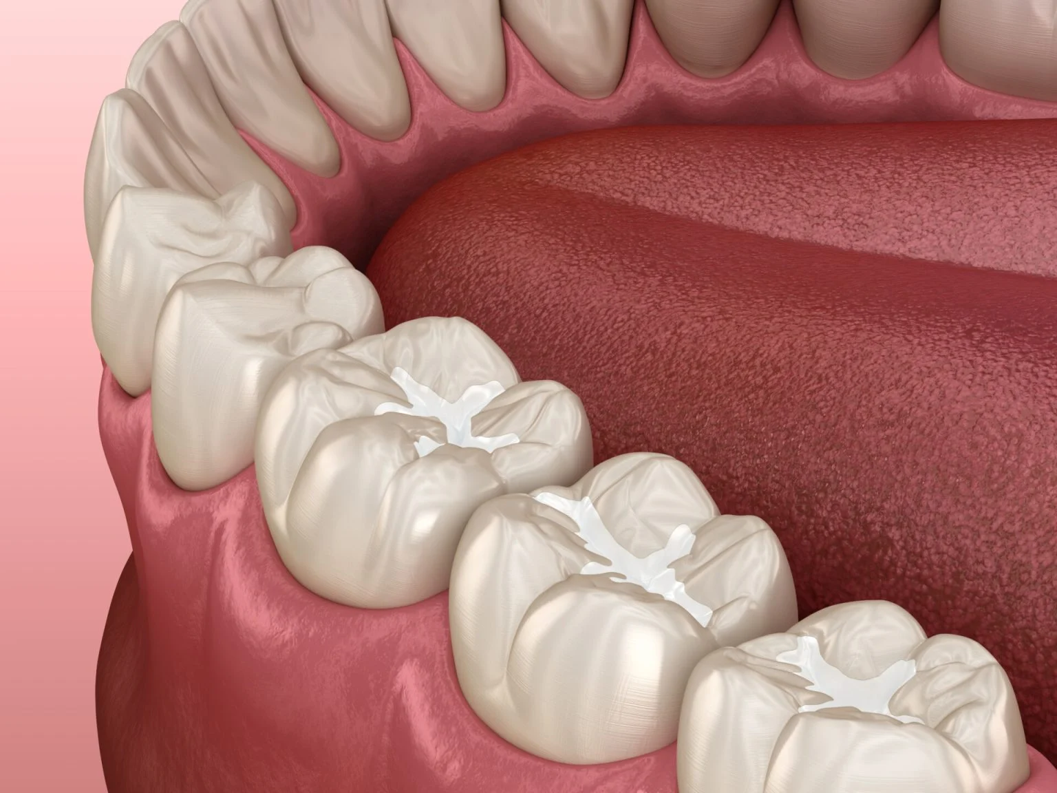 General Dentistry Dental Fillings - My Harmony Smiles
