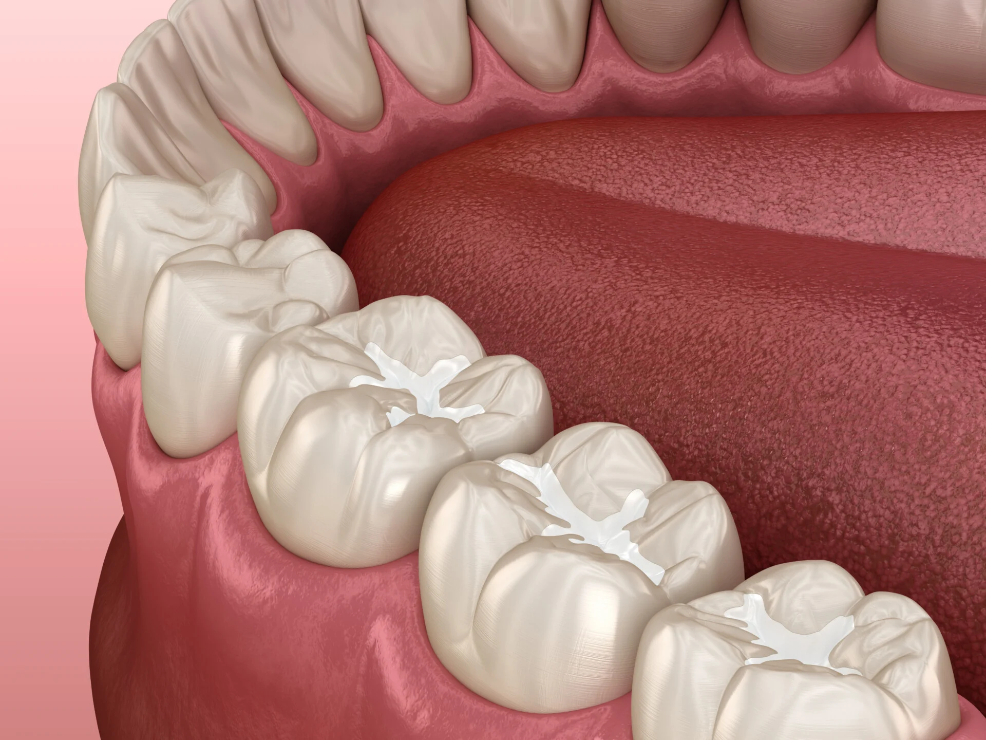 General Dentistry Dental Fillings - My Harmony Smiles