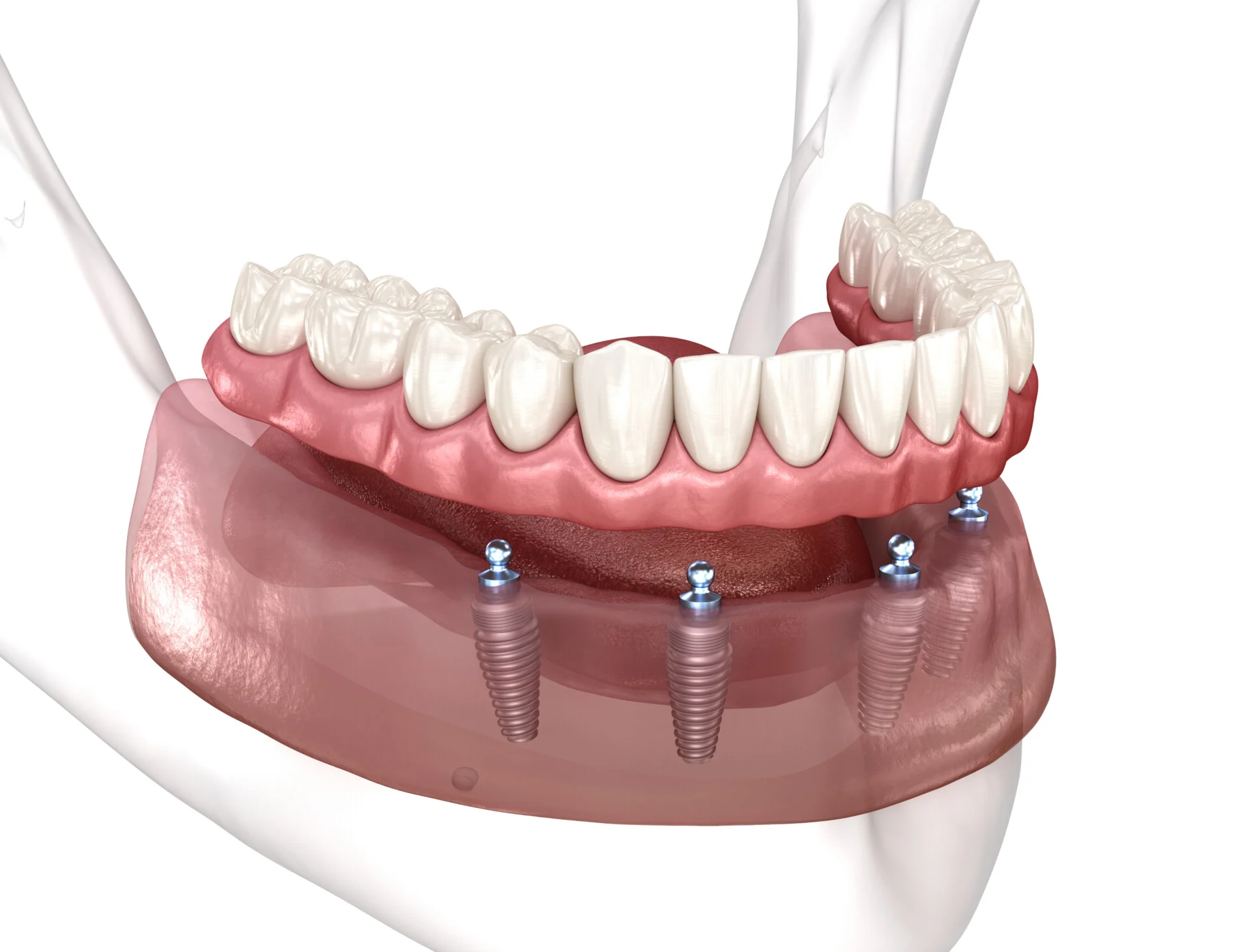 Restorative Dentistry Permanent Dentures - My Harmony Smiles