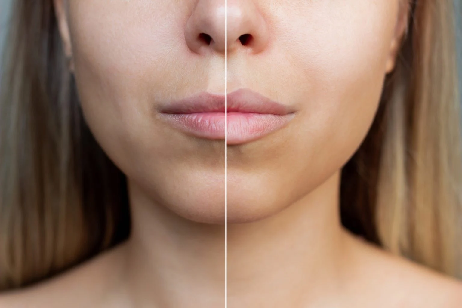 Facial aesthetics Fillers - My Harmony Smiles