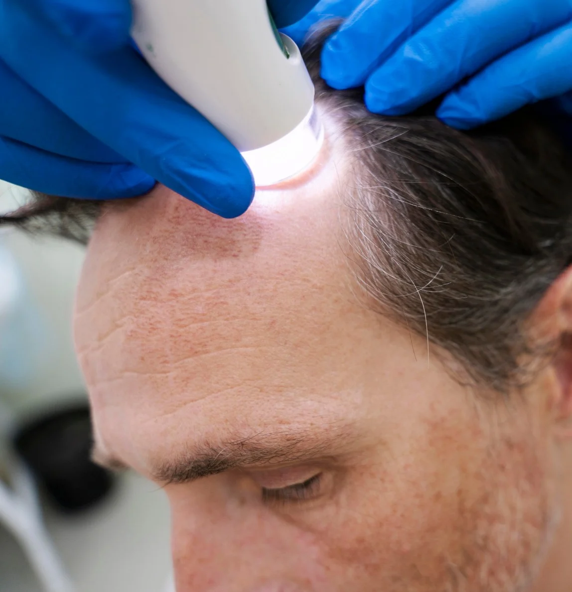Facial aesthetics Hair regeneration - My Harmony Smiles