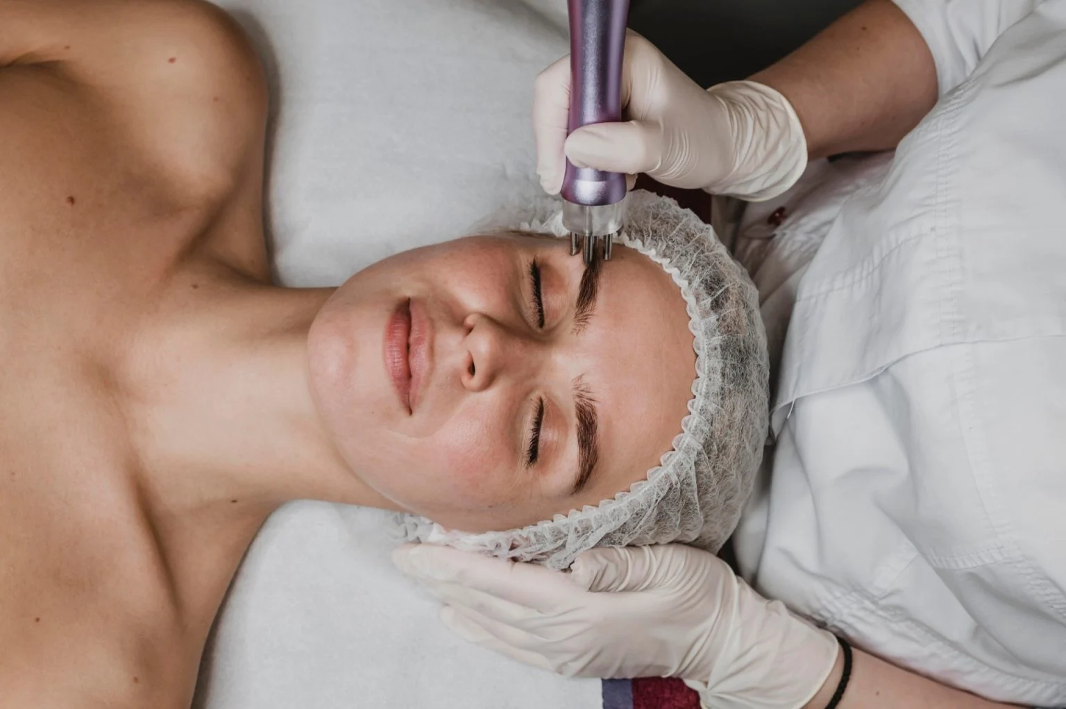 Facial aesthetics Micro-Needling Potenza - My Harmony Smiles