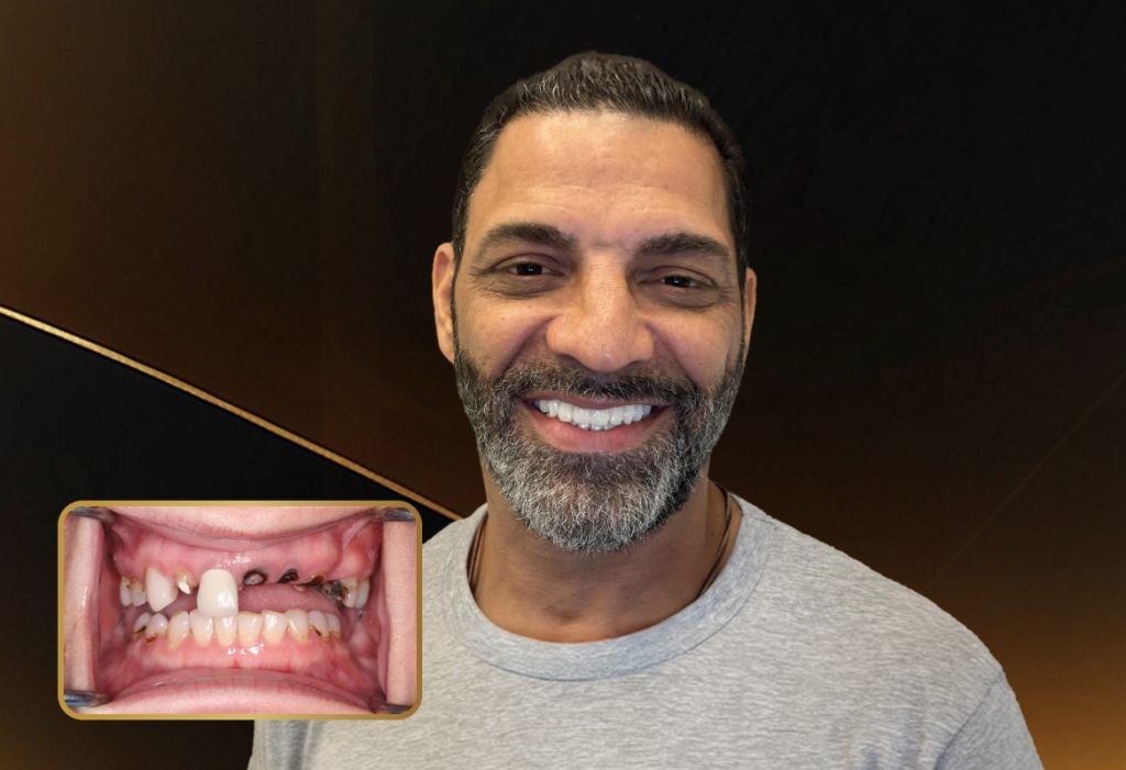 Restorative Dentistry Dental Implants - My Harmony Smiles