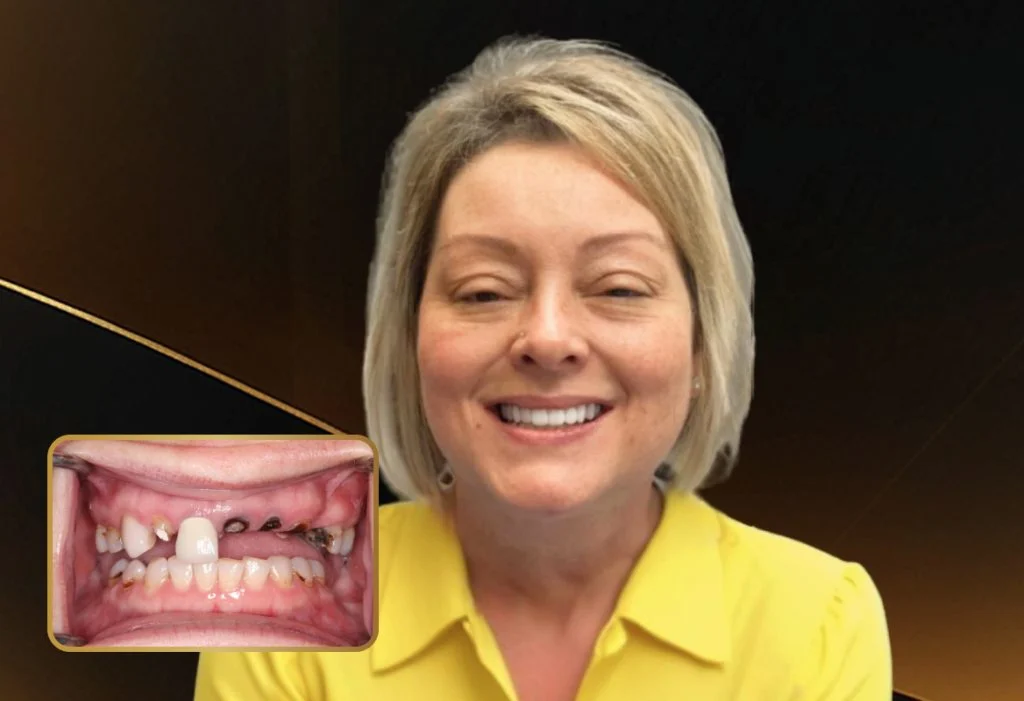 Restorative Dentistry All-On-X Dental Implants - My Harmony Smiles