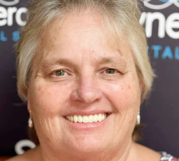 Restorative Dentistry Full Mouth Dental Implants - My Harmony Smiles