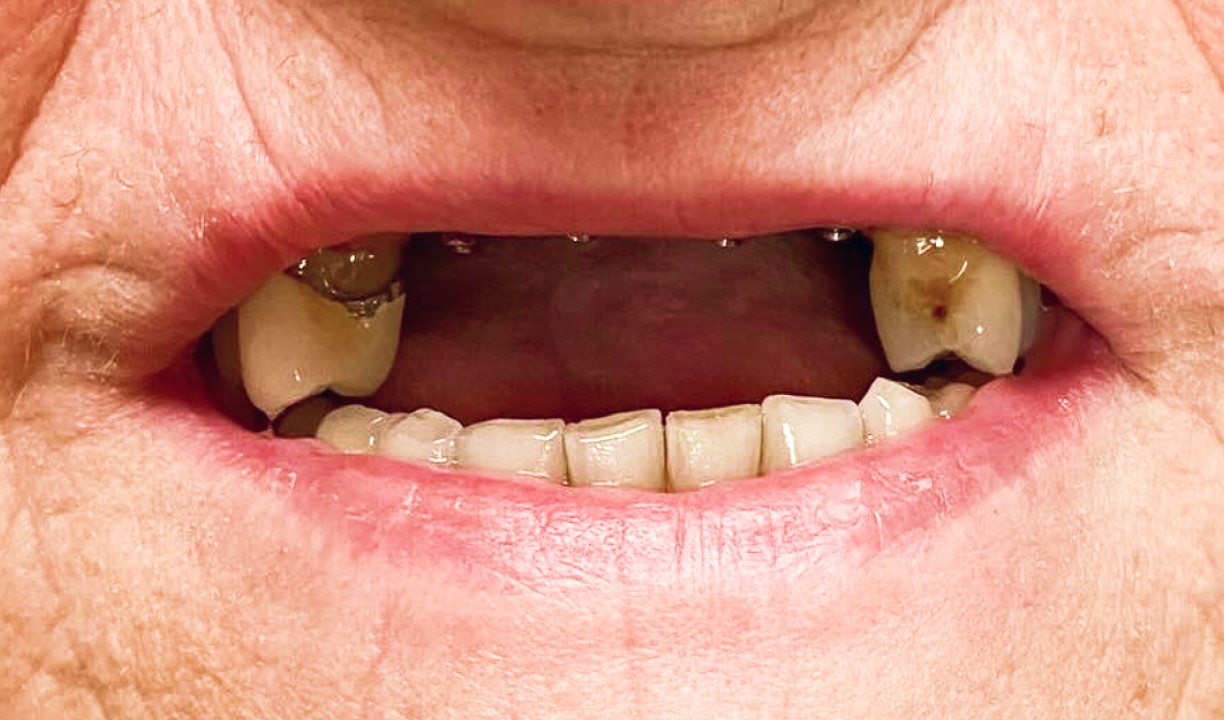 Restorative Dentistry Dental Implants - My Harmony Smiles