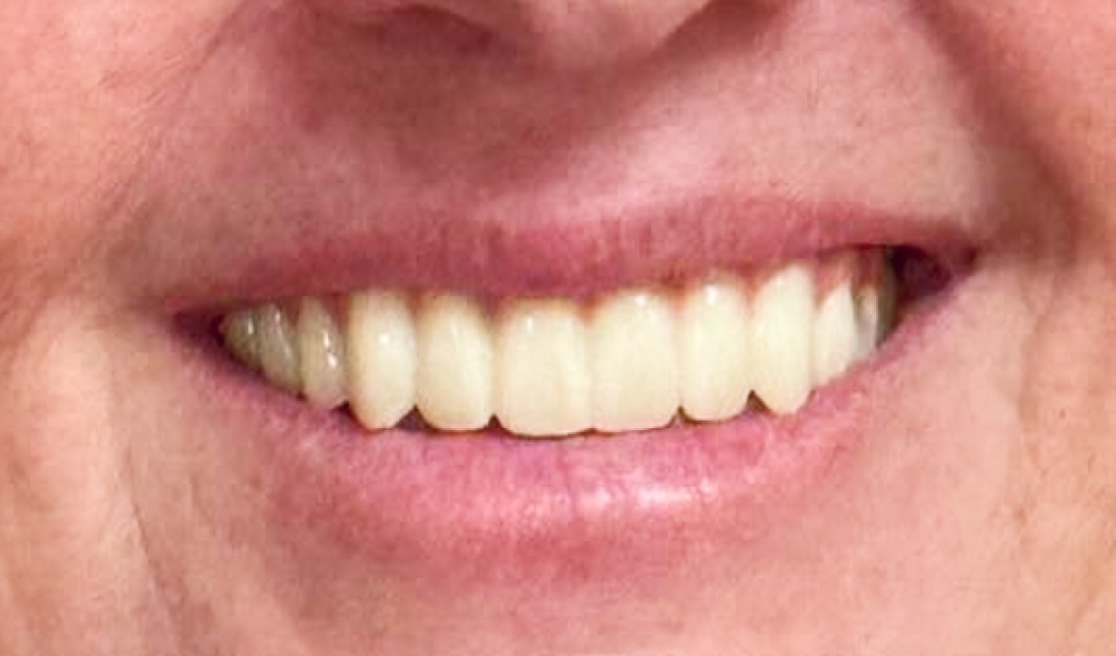 Restorative Dentistry Dental Implants - My Harmony Smiles
