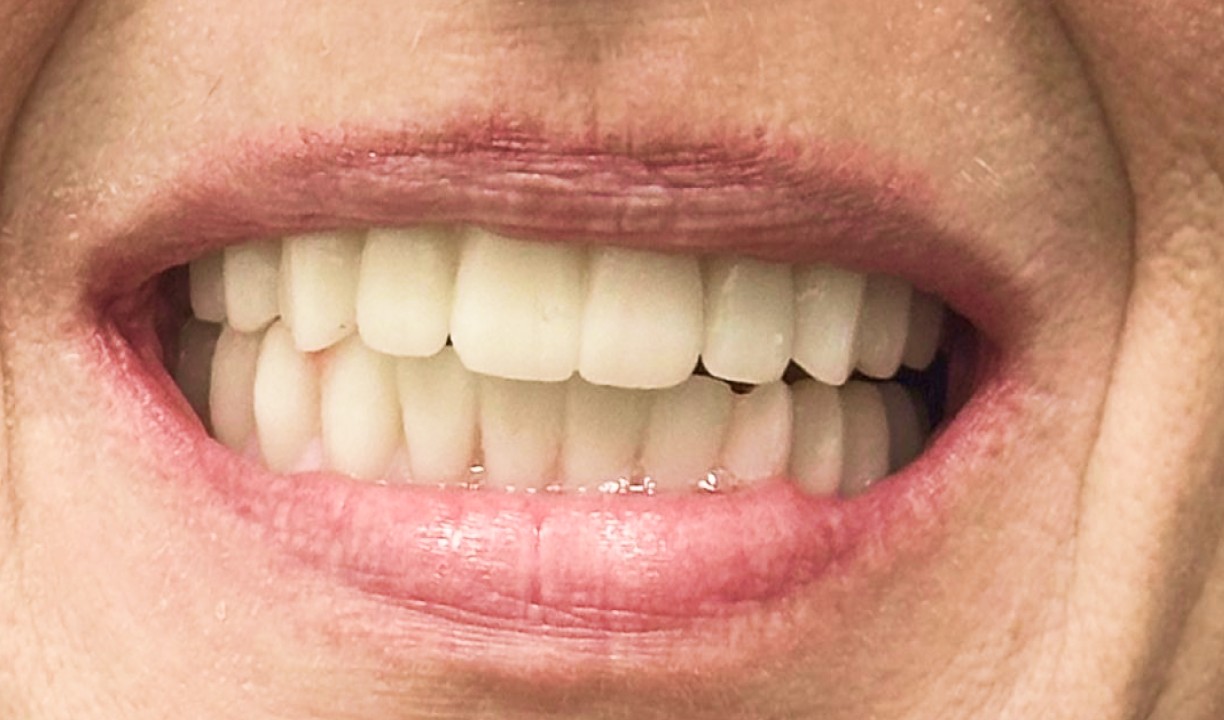 Restorative Dentistry Dental Implants - My Harmony Smiles