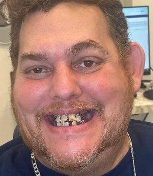 Facial aesthetics Micro-Needling Potenza - My Harmony Smiles