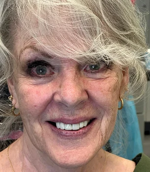 Facial aesthetics Micro-Needling Potenza - My Harmony Smiles