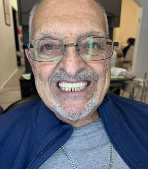 Facial aesthetics Micro-Needling Potenza - My Harmony Smiles