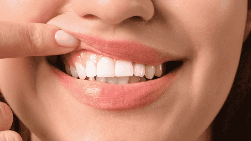 Long-Term Dental Health With Veneers