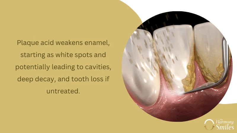 Destruction of Tooth Enamel and Cavity Development