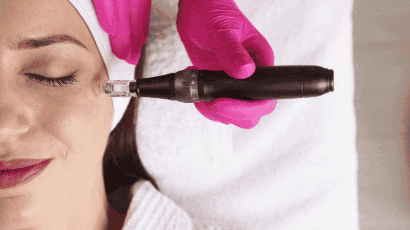 prf vs microneedling healing time