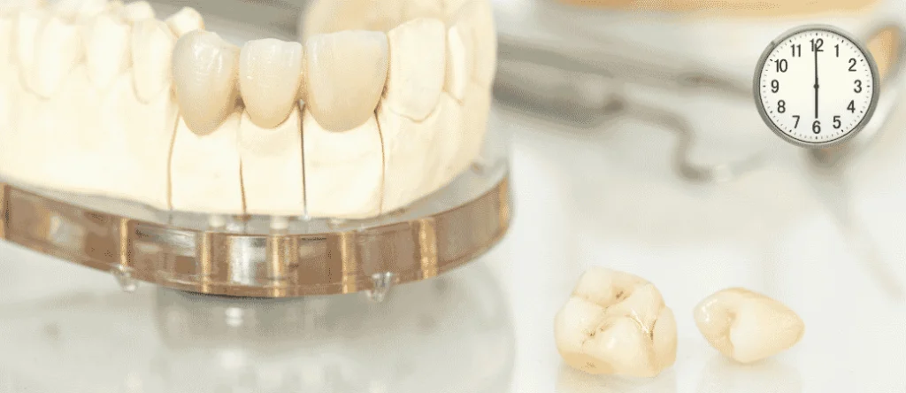 same day crowns Palm Harbor FL