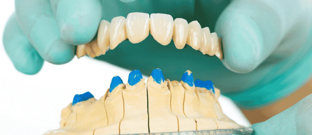 Dental Bridges and Fixed Bridges